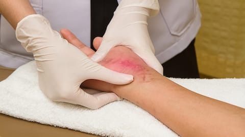 Wound Healing and Management